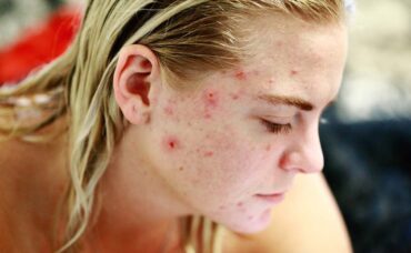 ‘Acne positivity’, la filosofía de amar los granitos de tu rostro